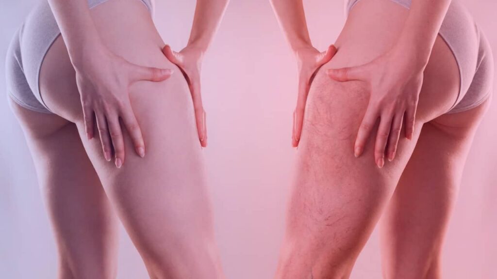 comprendre le lipoedème