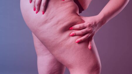 Quel protocole en 2026 pour guérir du lipœdème ? Traitement lipoedème 2026 : protocole complet et efficace