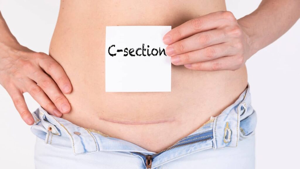 Césarienne : cette petite cicatrice cache en réalité une chirurgie bien plus lourde qu’on ne l’imagine c section