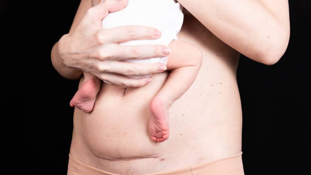 cicatrice cesarienne bébé