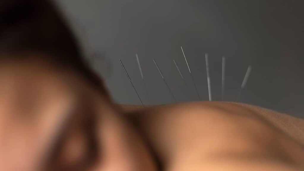 accupuncture dos