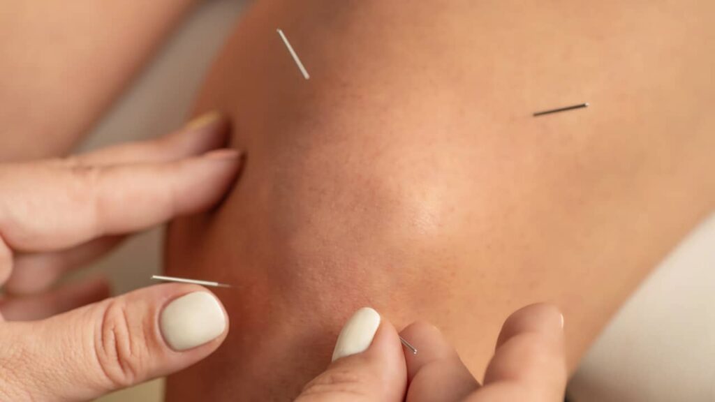 accupuncture genou